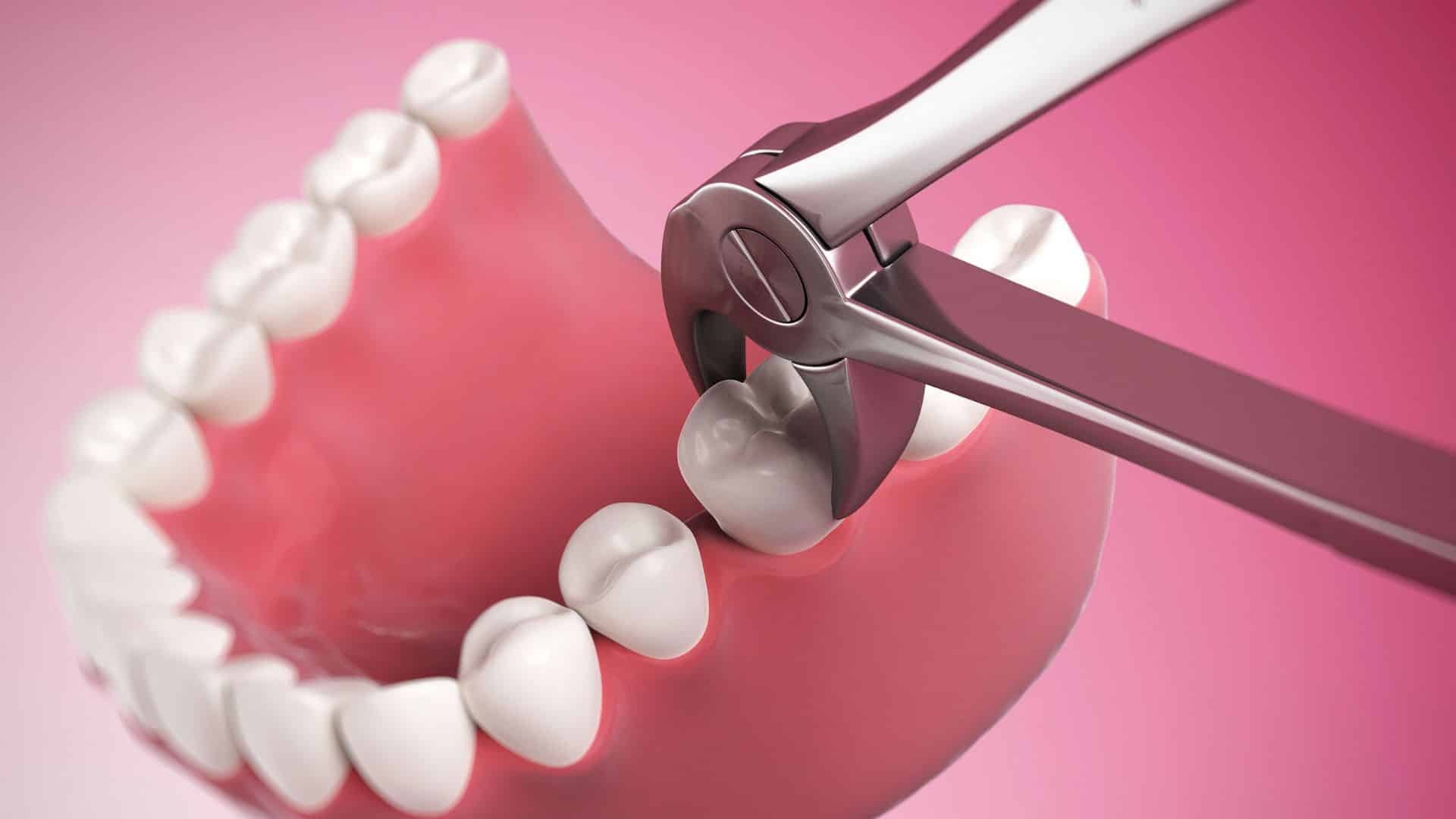 Dental forceps extracting a tooth from a model showing tooth extraction procedure.
