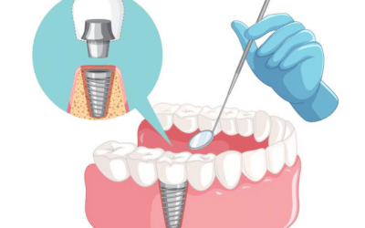 What To Eat After Dental Implant Surgery