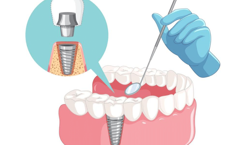 Dental Implants Phoenix Dental implant surgery illustration showing screw placement in jawbone with surgical tools and gloved hand.