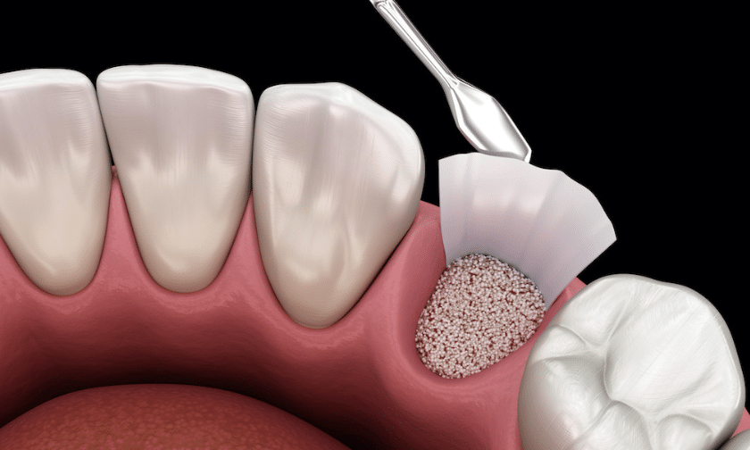 Dental bone graft illustration showing granulated bone material being placed into jaw socket for implant preparation.