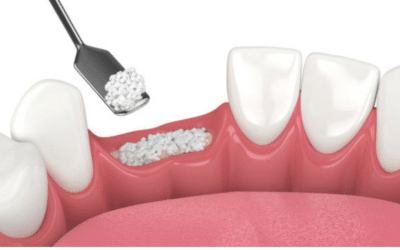 How Can Bone Grafting Improve the Dental Implant Process?