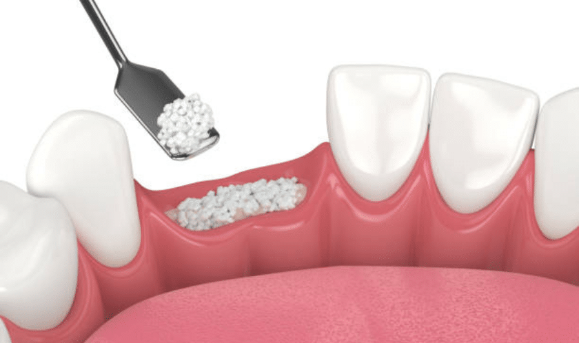 How Bone Grafting Can Improve The Dental Implants Process Dental bone graft procedure showing granules being applied to gum tissue between teeth.
