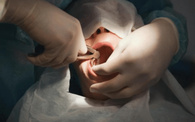 How To Prepare For Tooth Extraction, Prevent Pain, And Heal Faster