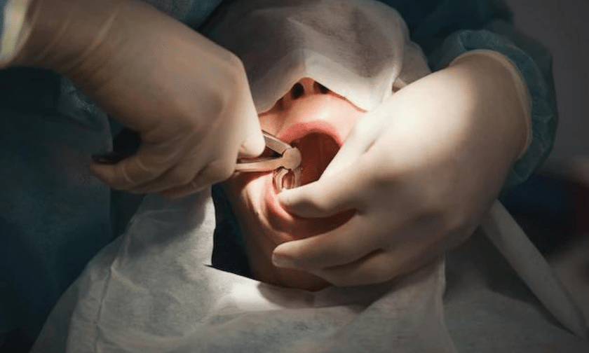 How To Prepare For Tooth Extraction, Prevent Pain, And Heal Faster Dentist performing tooth extraction procedure with surgical instruments and gloved hands.
