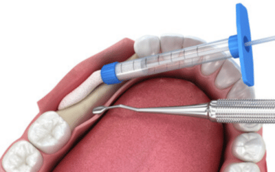 How Long Does Pain Last After A Dental Bone Graft? Here’s What You Need To Know