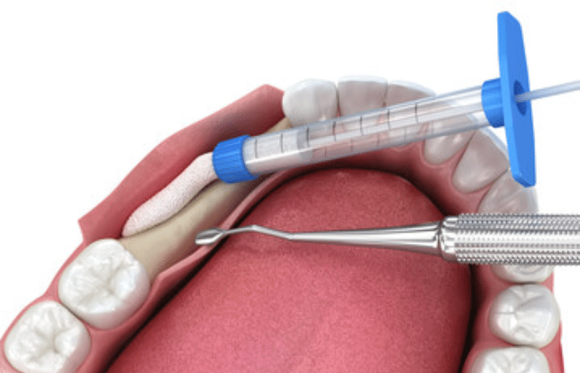 Dental bone graft procedure showing syringe injection and surgical instruments near tooth site.