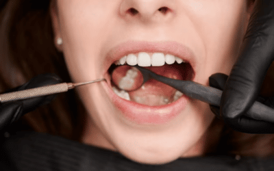 Preparing For Gum Graft Surgery: A Step-By-Step Guide