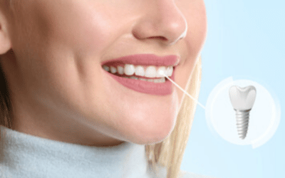 How long is the healing time for dental implants?