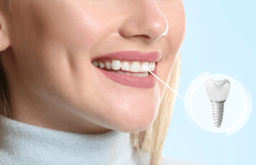 Woman smiling showing healthy white teeth with dental implant illustration in Phoenix.