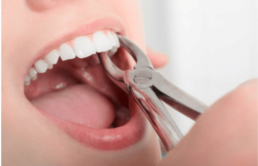 Dentist extracting a tooth with forceps during a dental extraction procedure.