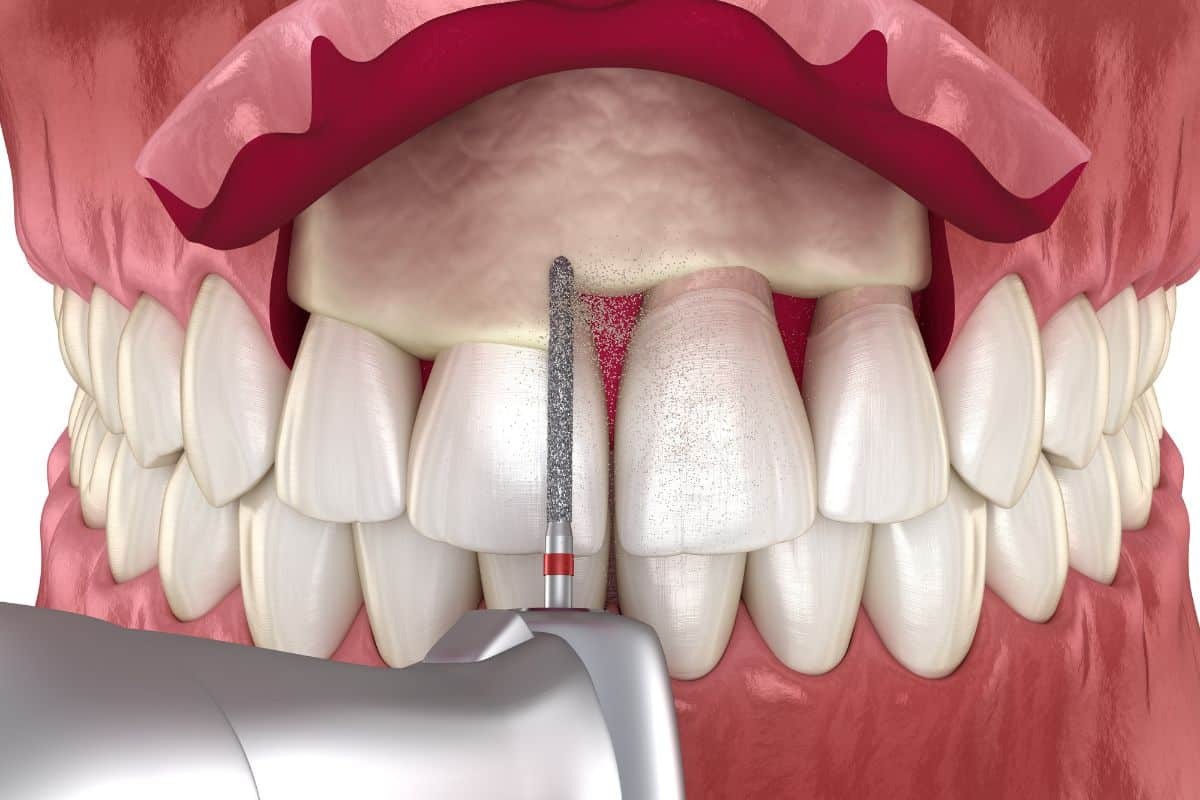 Crown lengthening procedure showing gum tissue removal with dental bur on front teeth.