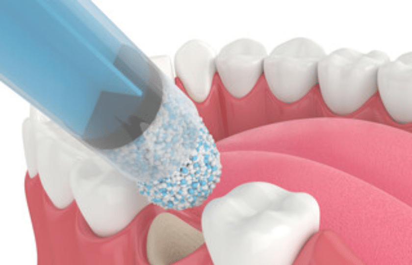 Dental bone graft procedure showing graft material application to jawbone for implant placement.