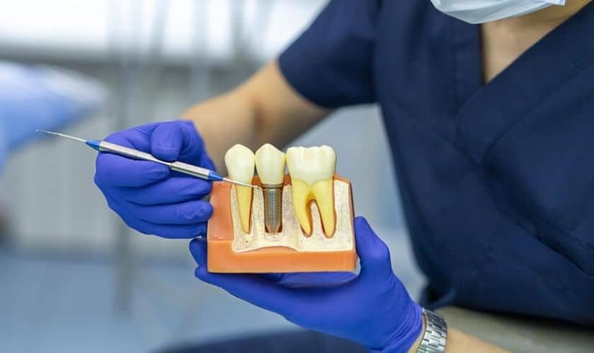 Dental Implants Dentist demonstrating dental implant cross-section model with natural teeth comparison.