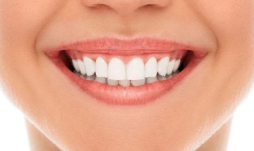 Close-up of a patient's bright white smile showing healthy teeth after gummy smile treatment.
