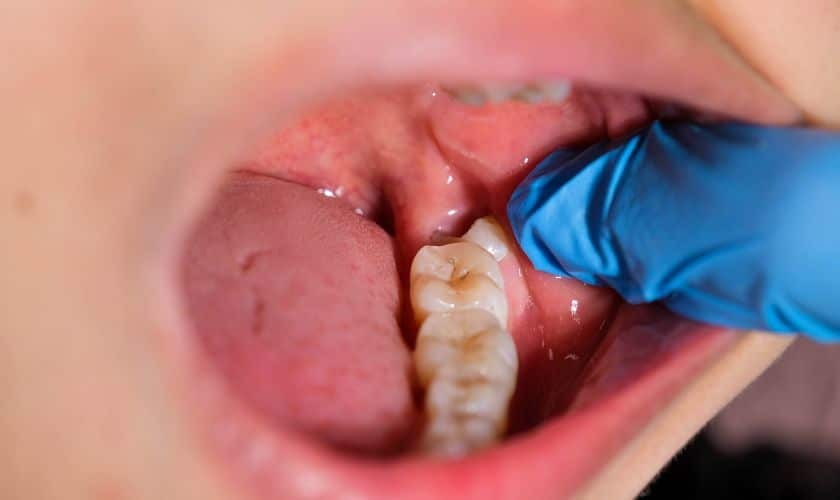 Gum Recession in Phoenix Close-up of pinhole gum surgery procedure showing gum recession treatment in Phoenix.