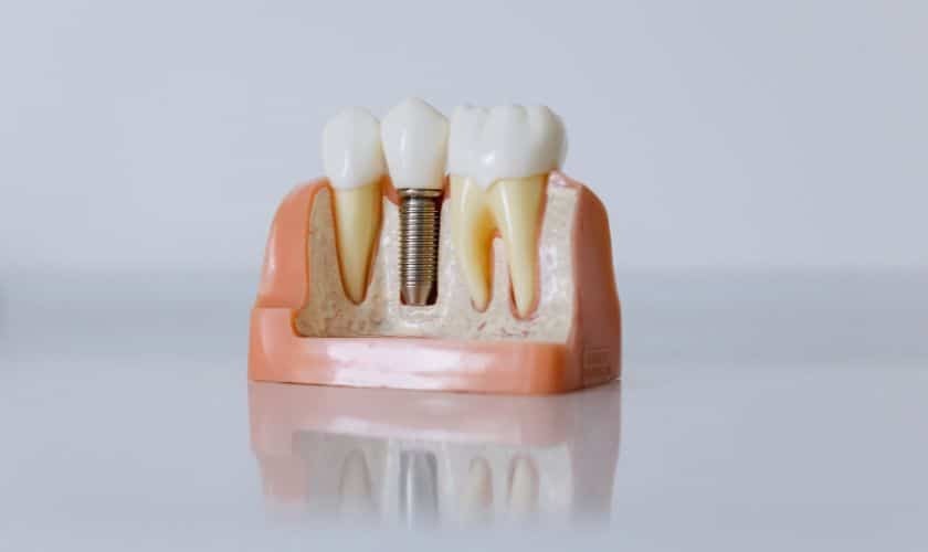 dental implants in phoenix Dental implant model showing titanium screw between natural teeth in Phoenix.