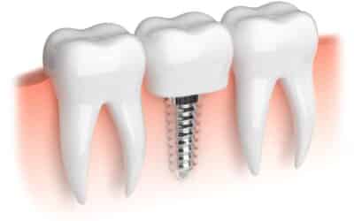 Choosing Dental Implants: Benefits and Consideration