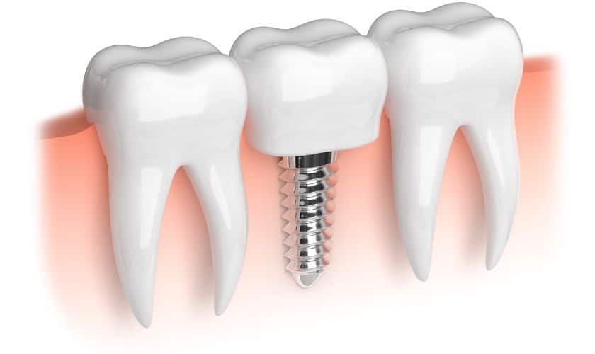 Dental Implant in Phoenix (1)(1) Dental implant illustration showing a titanium screw anchored in jawbone between two natural teeth.