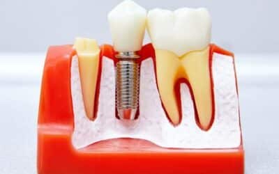 Dental Implants: A Long-Term Replacement for Missing Teeth