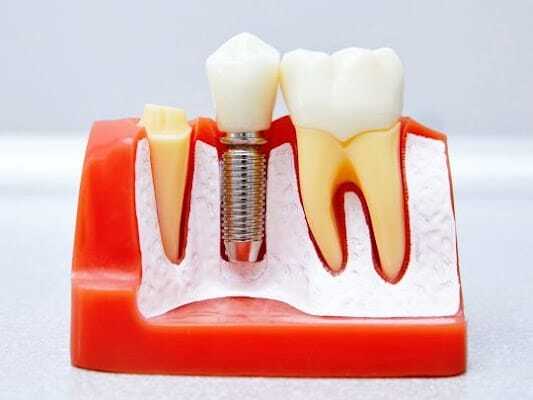 Dental implant model showing titanium post, abutment, and crown next to natural teeth.