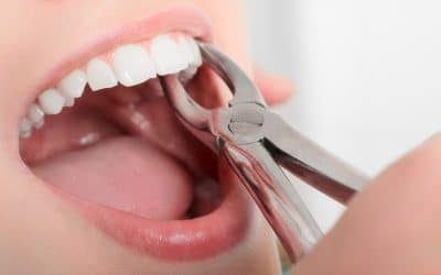 How do you choose between tooth extractions and a root canal?