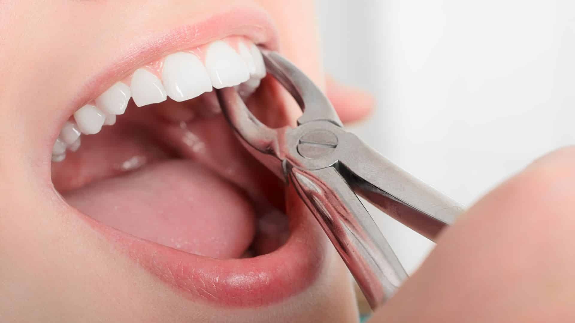 Dental extraction procedure showing forceps removing a tooth from patient's mouth.