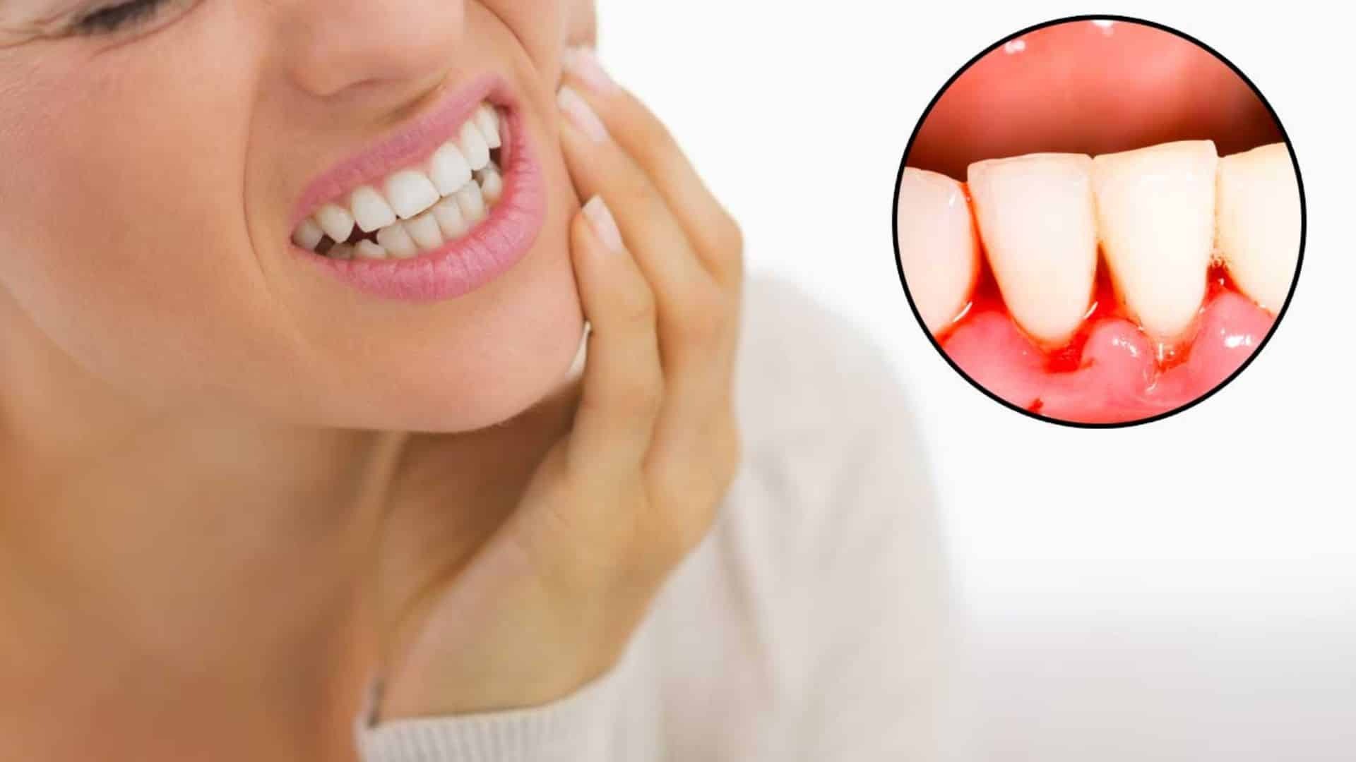 Treat Periodontal Disease Woman with tooth pain showing inflamed gums and bleeding between teeth.