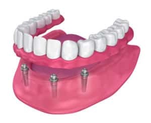 How Many Implants Are Required for Full Mouth Tooth Replacement?
