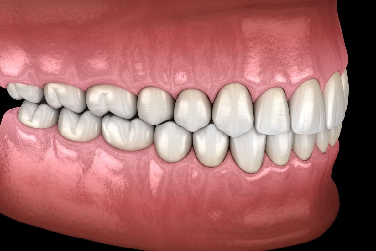 What is Occlusal Therapy and Why is it Important 3D dental model showing proper tooth alignment and occlusion for occlusal therapy treatment.