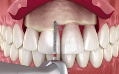 Concepts and Considerations for Surgical Crown Lengthening