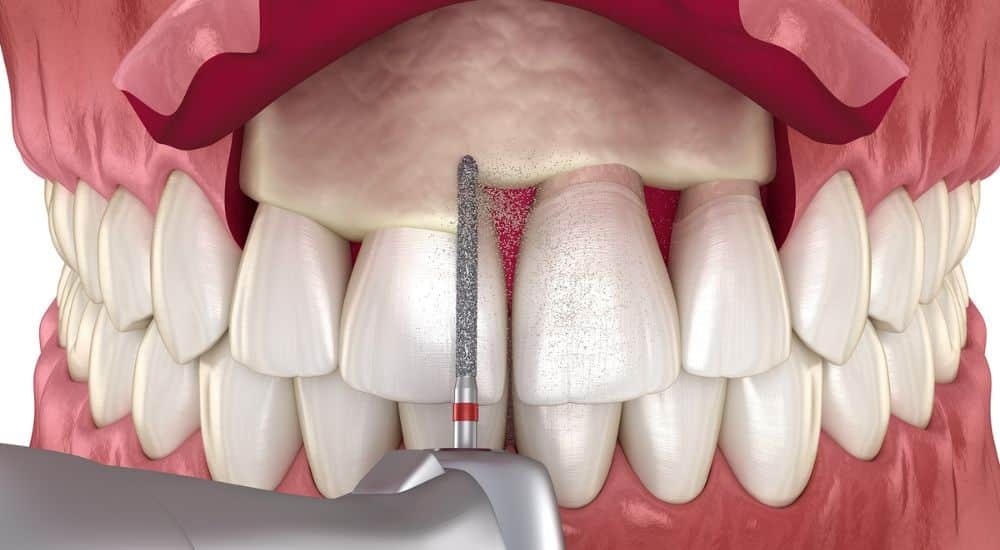 Surgical crown lengthening procedure showing gum tissue removal with dental bur to expose tooth structure.
