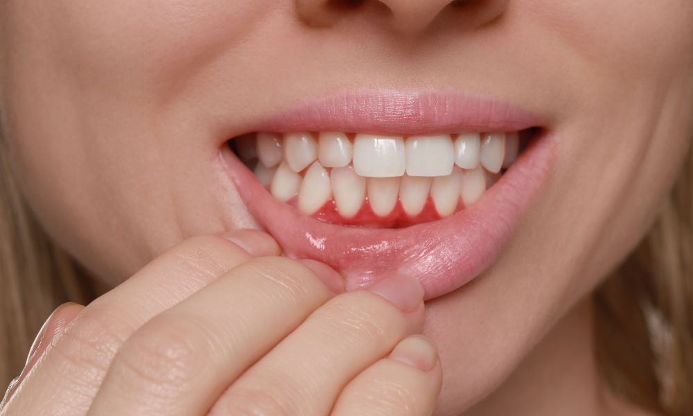 Tips to Keep Your Gums Healthy Close-up of healthy gums and white teeth showing signs of gum inflammation and bleeding.