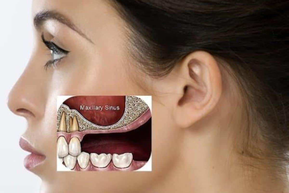 Anatomical diagram showing maxillary sinus and upper front teeth for dental sinus grafting education.