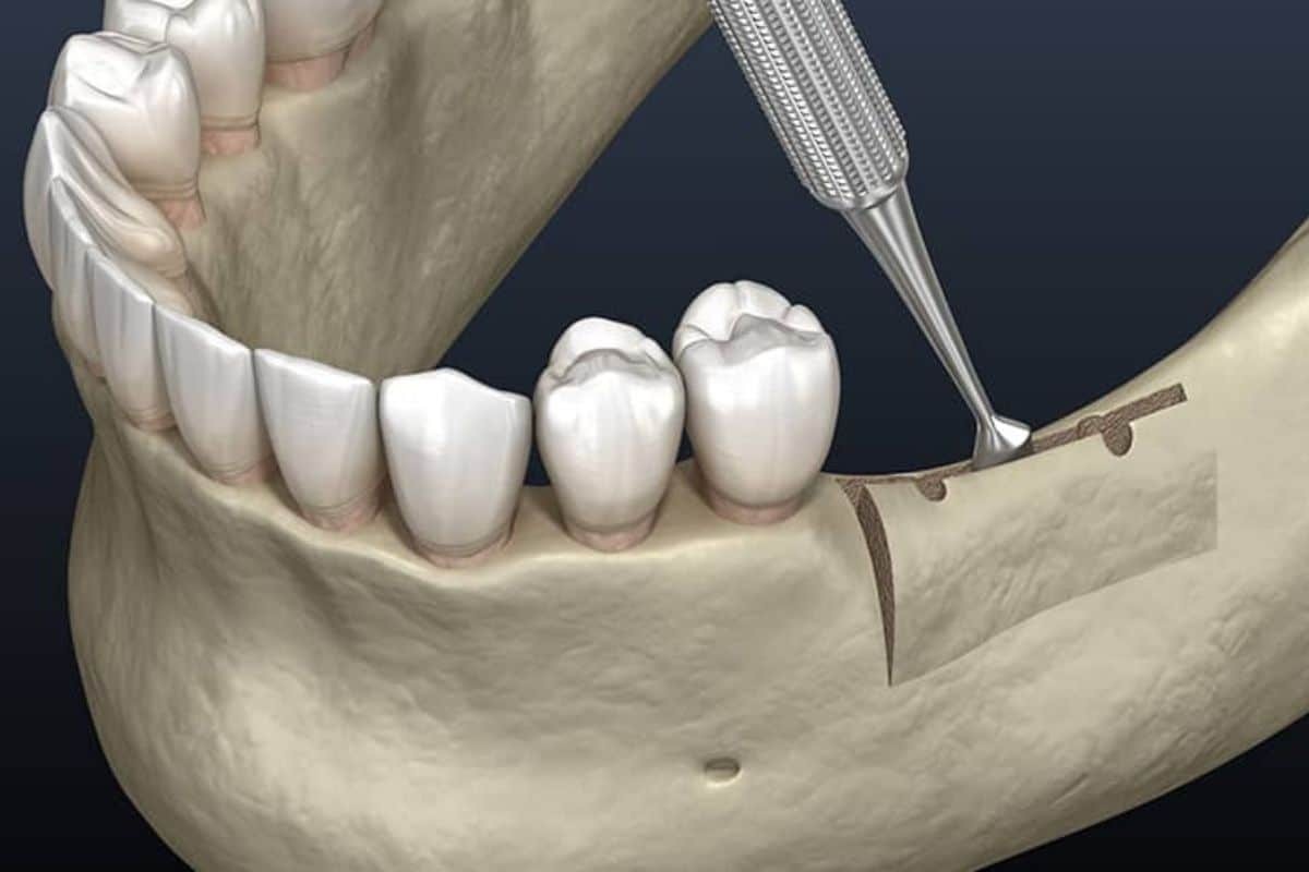 Dental implant placement with bone graft augmentation showing dental drill and restored teeth on jawbone model.