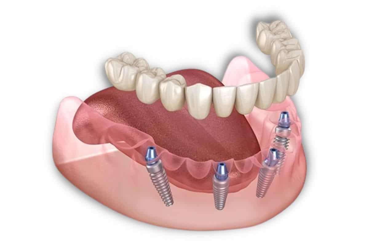 Teeth in a Day A Myth or Reality How the Dental Implant Process Works Dental implants supporting a full arch prosthetic bridge with four titanium implant posts in the jawbone.