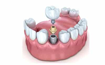 What are the Different Types of Dental Implants?