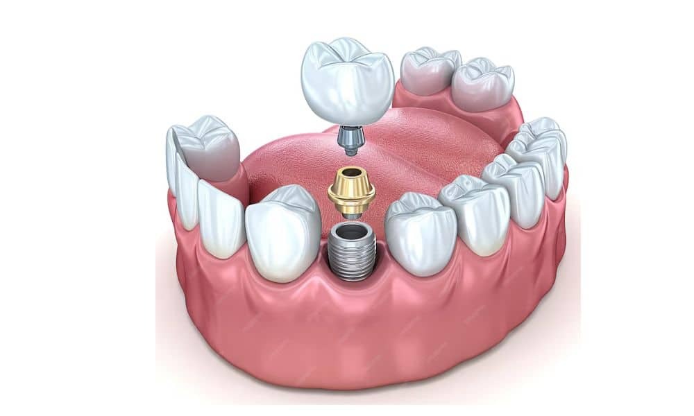 3D dental implant diagram showing titanium screw, abutment, and crown replacing a missing tooth in Phoenix.