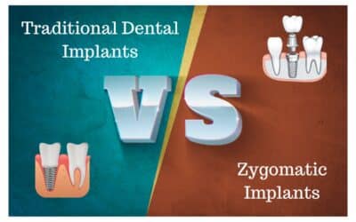 What’s the Difference Between Traditional Dental and Zygomatic Implants?