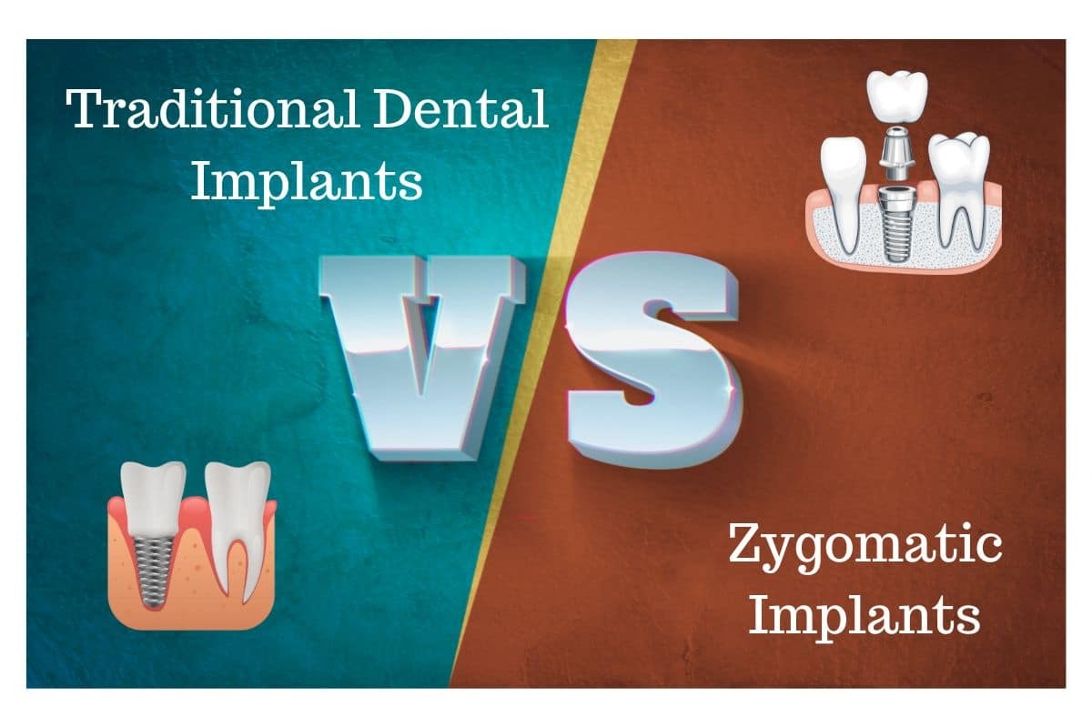 Traditional Dental and Zygomatic Implants Comparison of traditional dental implants versus zygomatic implants for tooth replacement.