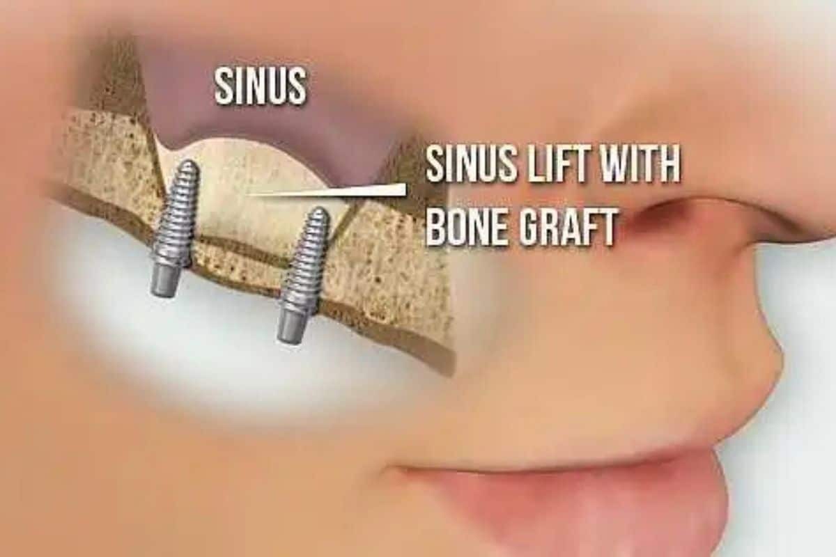 Sinus lift procedure diagram showing bone graft placement with dental implants for jaw restoration.
