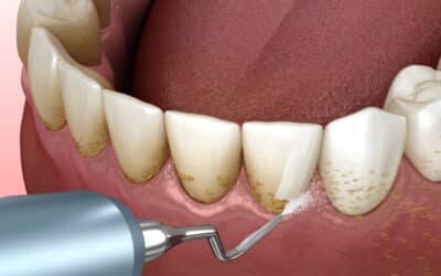 Top 10 Benefits of Scaling & Root Planing for Your Oral Health
