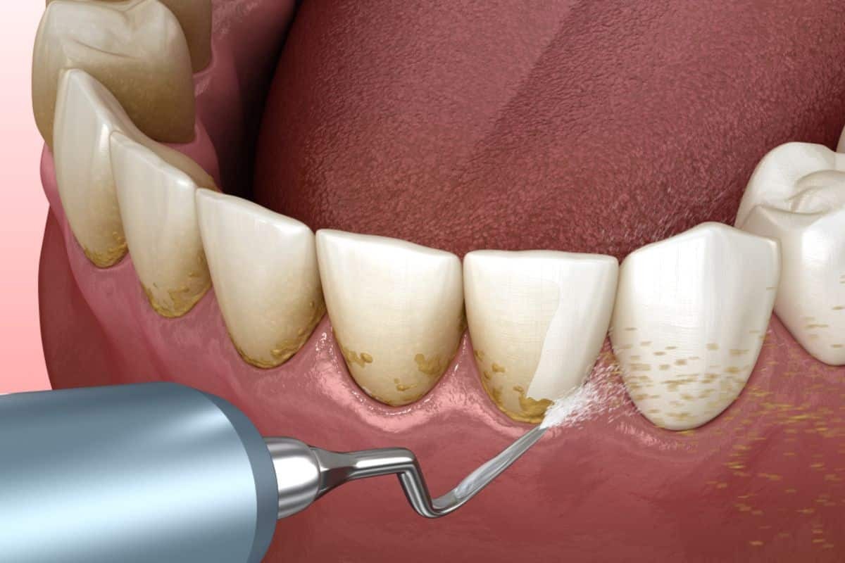 10 Benefits of Scaling & Root Planing Scaling and root planing treatment removing tartar buildup from teeth near Phoenix.