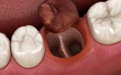 How to Treat Dry Sockets: A Comprehensive Guide