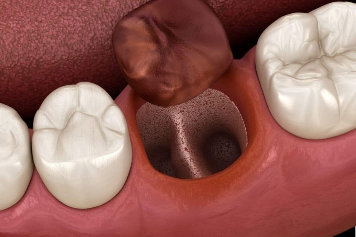 3D illustration of dry socket treatment showing exposed tooth socket between healthy teeth.