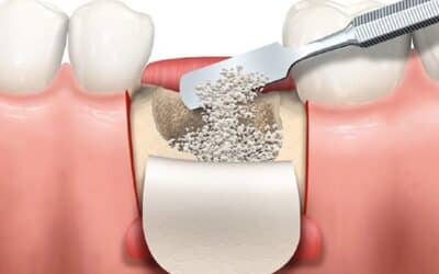 Types of Bone Grafts Used in Oral Surgery