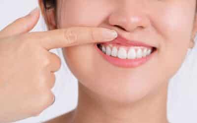 Fixing Gum Overgrowth with Gingivectomy