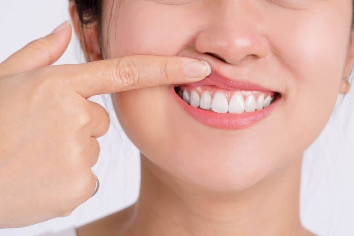 Woman pointing to her gum line while smiling, showing healthy teeth and gums after gingivectomy treatment.