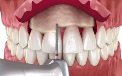 What Happens After Esthetic Crown Lengthening? Recovery and Aftercare Tips