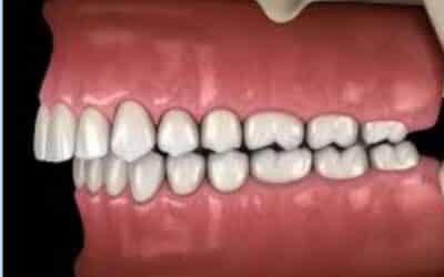 How an Anterior Bite Plane Helps Correct Malocclusions