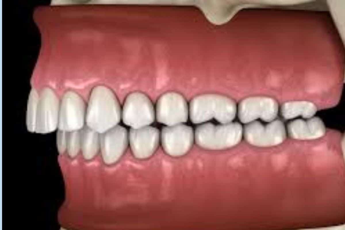 How an Anterior Bite Plane Helps Correct Malocclusions Anterior bite plane diagram showing upper and lower teeth alignment for malocclusion correction.